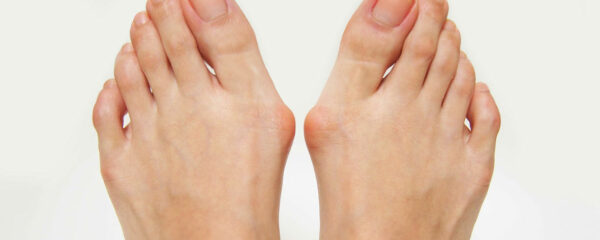 Hallux Valgus