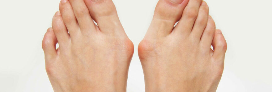 Hallux Valgus